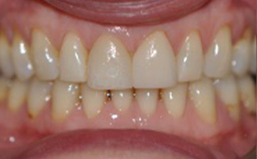 After - Bassett Dental & Aesthetics