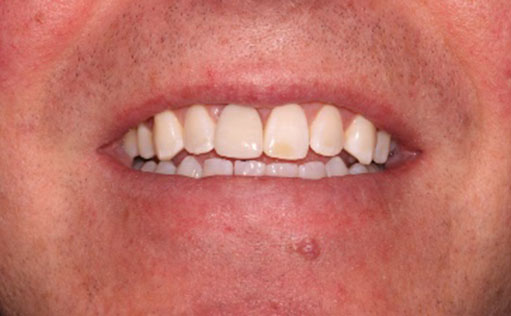 After - Bassett Dental & Aesthetics