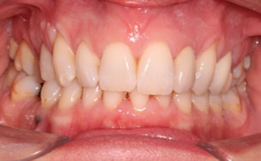 After - Bassett Dental & Aesthetics