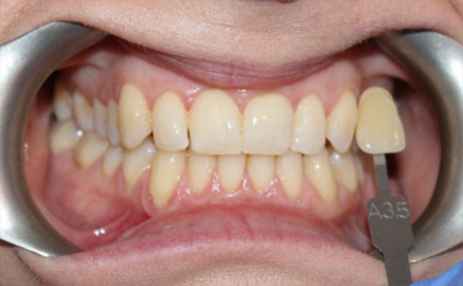 Before - Bassett Dental & Aesthetics