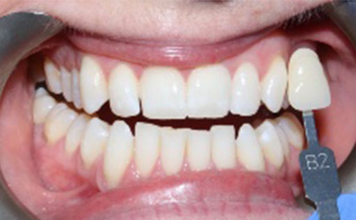 After - Bassett Dental & Aesthetics