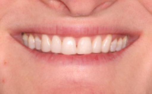 After - Bassett Dental & Aesthetics