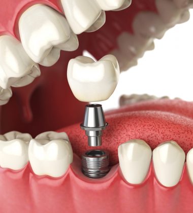 BassettDental - treatment